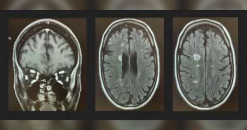  Рис. 3. МРТ головного мозку та орбіт Т1 із пригніченням жирової тканини коронки й Т2 зображення показали кілька гіперінтенсивних уражень над шлуночковою системою без посилення зорового нерва або ознак невриту зорового нерва
